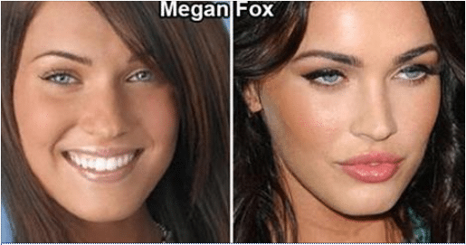 Plastic surgery Aftermath